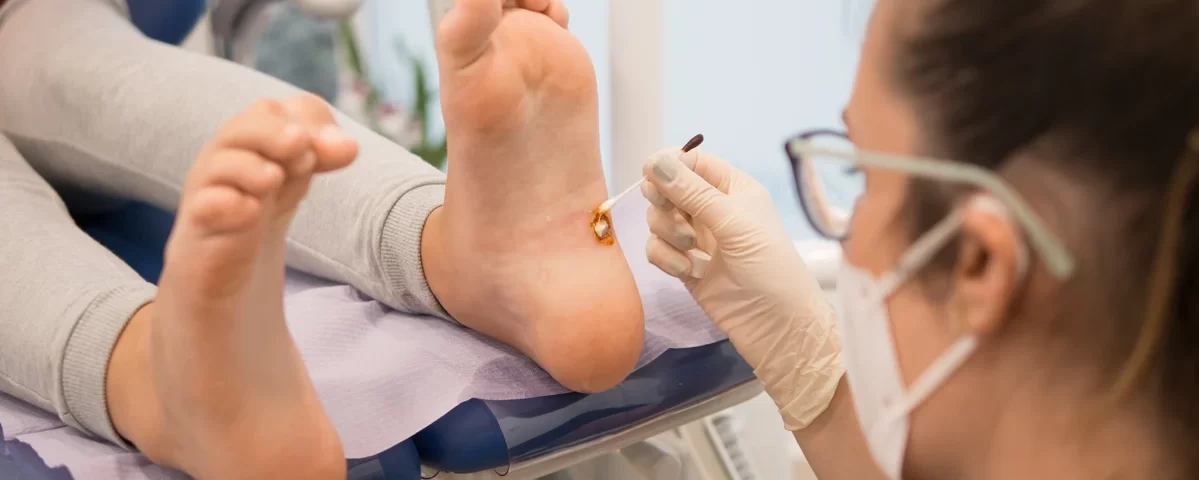 Usuwanie kurzajek w Warszawie