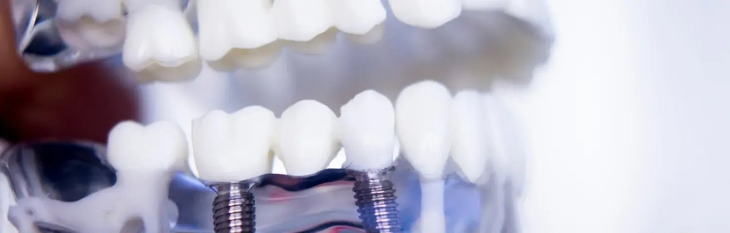 Implanty zębów cała szczęka cena Warszawa