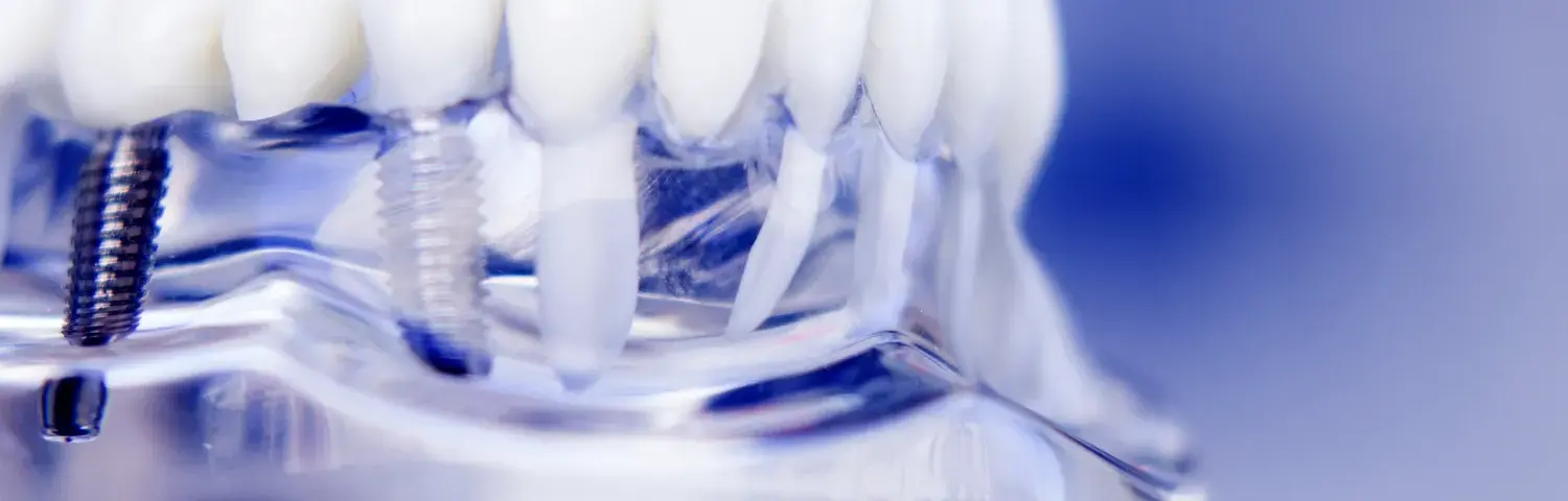 Klinika implantologiczna Warszawa