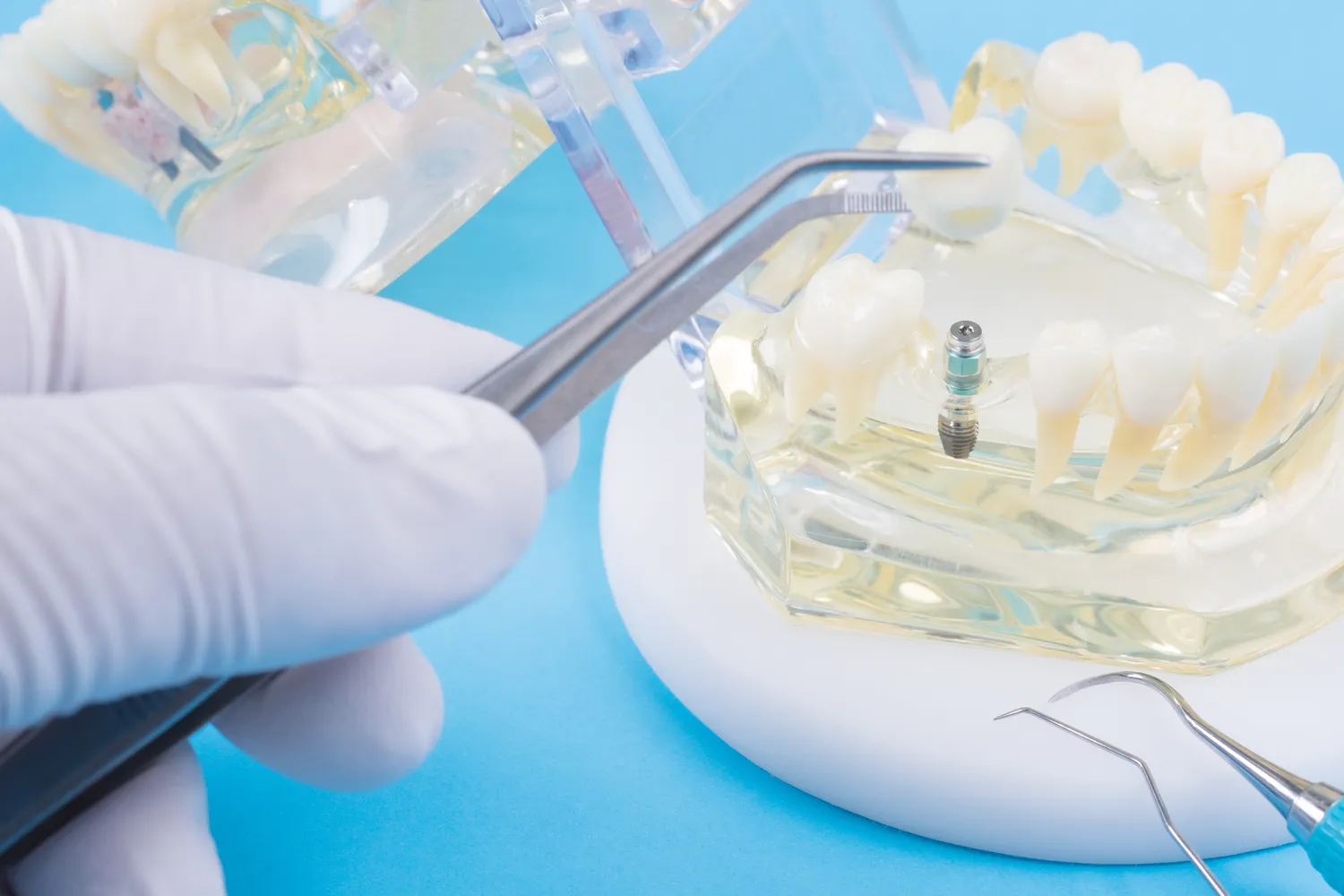 Implanty zębowe Szczecin cennik